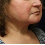 Levinelift Before & After Patient #11825