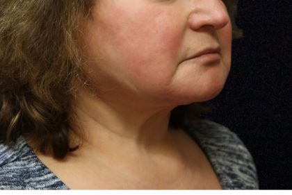 Levinelift Before & After Patient #11825