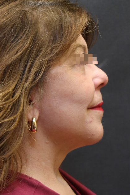 Levinelift Before & After Patient #11791