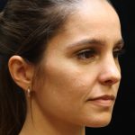 Rhinoplasty Before & After Patient #11947