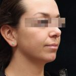 Rhinoplasty Before & After Patient #11948