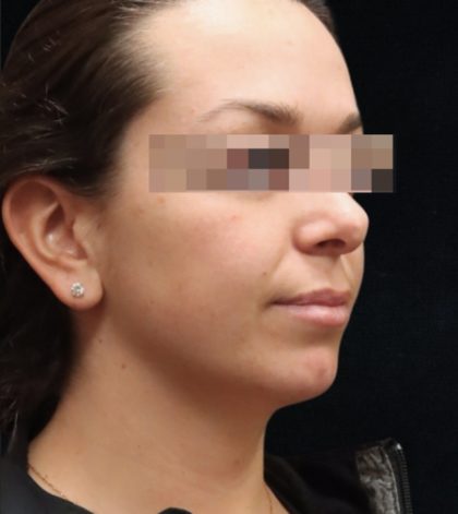 Rhinoplasty Before & After Patient #11948