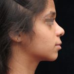 Rhinoplasty Before & After Patient #11949