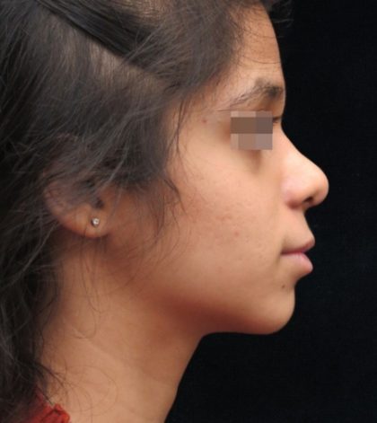 Rhinoplasty Before & After Patient #11949