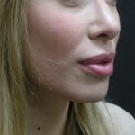 Rhinoplasty Before & After Patient #11950