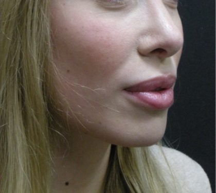Rhinoplasty Before & After Patient #11950