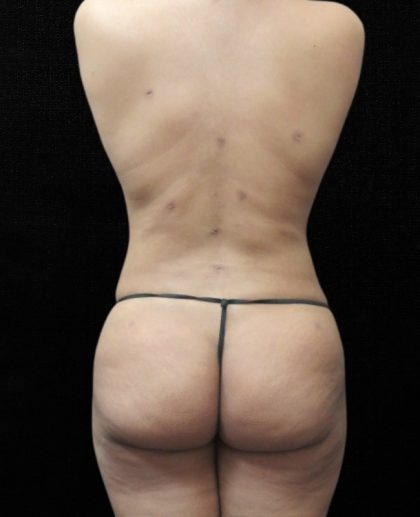 Liposuction Before & After Patient #11546