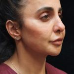 Rhinoplasty Before & After Patient #11951