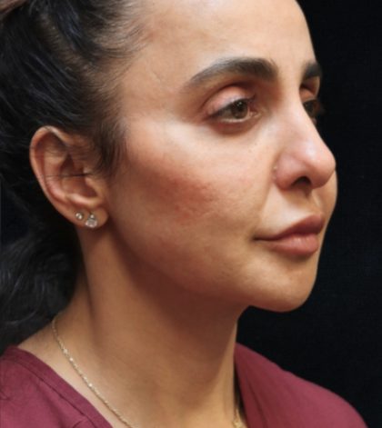 Rhinoplasty Before & After Patient #11951