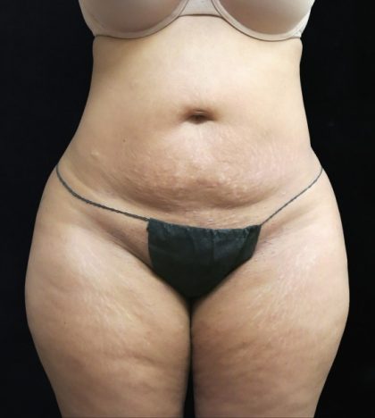 Liposuction Before & After Patient #11540