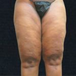 Liposuction Before & After Patient #11550