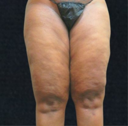 Liposuction Before & After Patient #11550