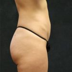 Liposuction Before & After Patient #11552