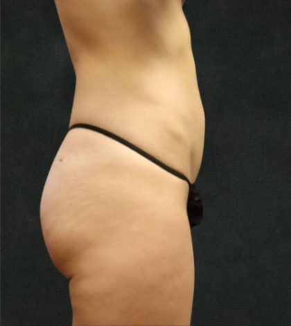 Liposuction Before & After Patient #11552