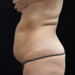 Liposuction Before & After Patient #11545