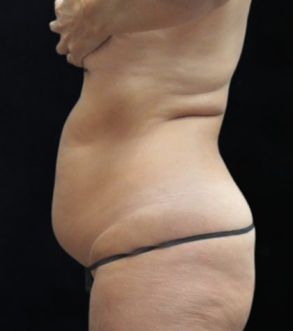 Liposuction Before & After Patient #11545