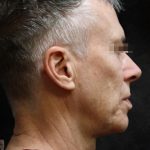Facelift Before & After Patient #11661