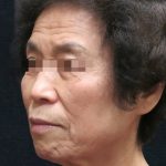 Facelift Before & After Patient #11664