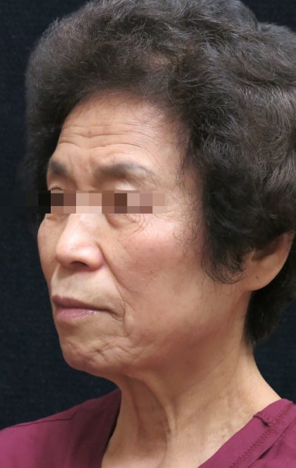Facelift Before & After Patient #11664