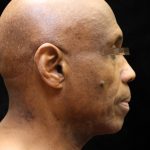 Facelift Before & After Patient #11665