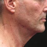 Facelift Before & After Patient #11666