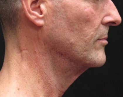 Facelift Before & After Patient #11666