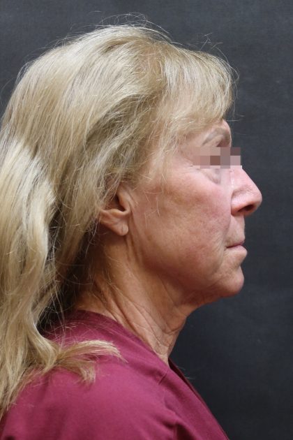 Facelift Before & After Patient #11662
