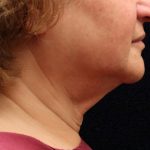 Facelift Before & After Patient #11667