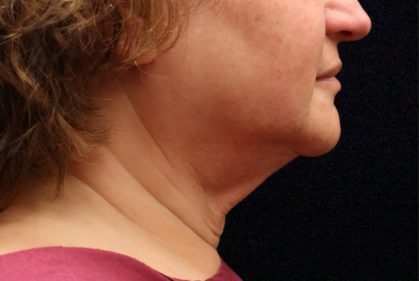Facelift Before & After Patient #11667