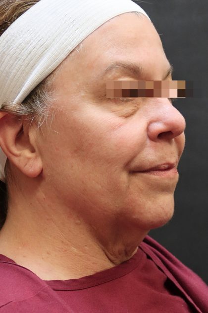 Facelift Before & After Patient #11663