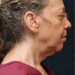 Levinelift Before & After Patient #11787