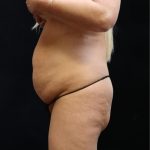 Liposuction Before & After Patient #11548