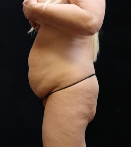 Liposuction Before & After Patient #11548