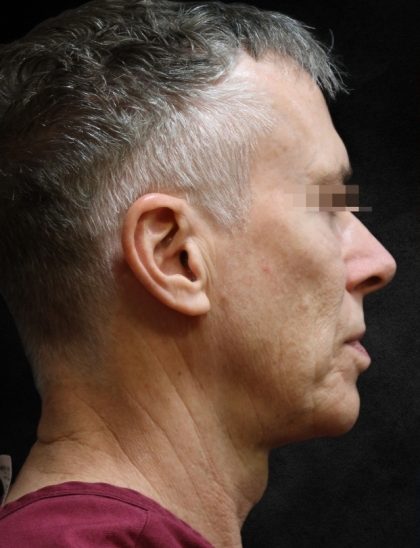Levinelift Before & After Patient #11789