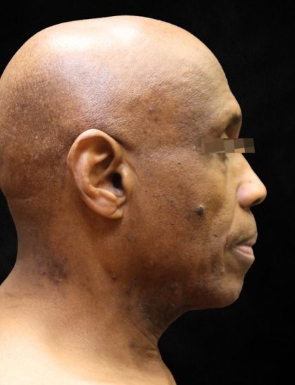 Levinelift Before & After Patient #11792