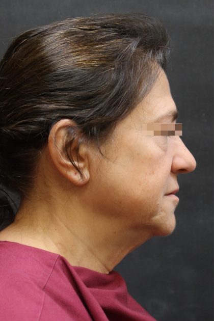 Levinelift Before & After Patient #11788