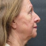 Levinelift Before & After Patient #11793