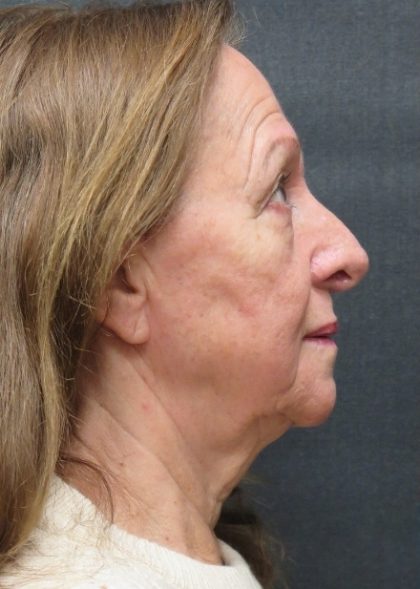 Levinelift Before & After Patient #11793