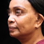 Levinelift Before & After Patient #11819