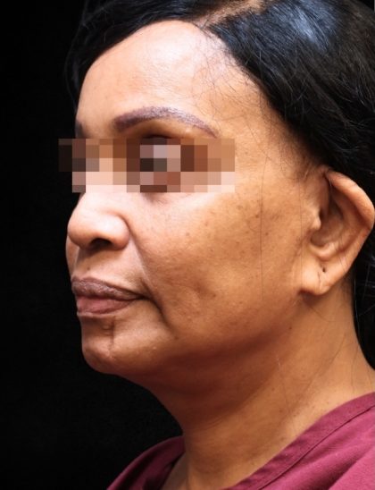 Levinelift Before & After Patient #11819