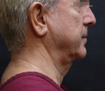 Levinelift Before & After Patient #11824