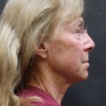 Levinelift Before & After Patient #11790