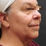 Levinelift Before & After Patient #11791
