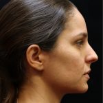 Rhinoplasty Before & After Patient #11947