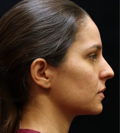 Rhinoplasty Before & After Patient #11947