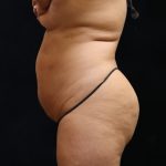 Liposuction Before & After Patient #11549