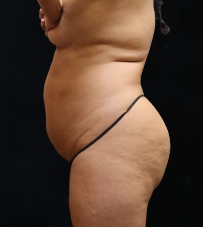 Liposuction Before & After Patient #11549