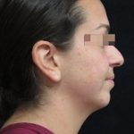 Rhinoplasty Before & After Patient #11948