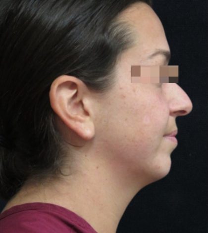 Rhinoplasty Before & After Patient #11948