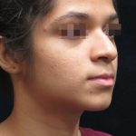 Rhinoplasty Before & After Patient #11949
